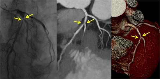 CT coronary angiography in the assessment of significant coronary artery {faces}